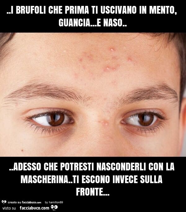 I brufoli che prima ti uscivano in mento, guancia… e naso… adesso che potresti nasconderli con la mascherina. Ti escono invece sulla fronte